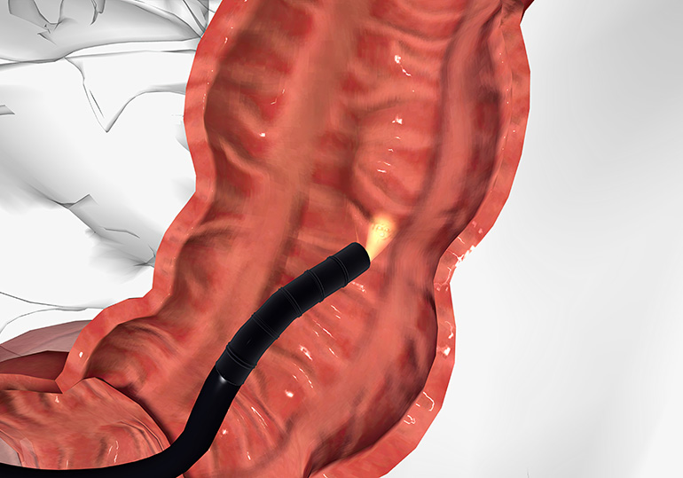 Colonoscopia – Clínica Endocolo Saúde Intestinal
