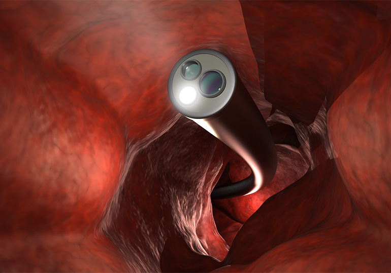 endoscopia-digestiva-alta